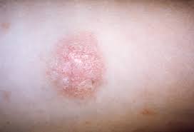 Pityriasis Rosea