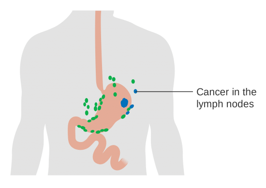 Stomach Cancer