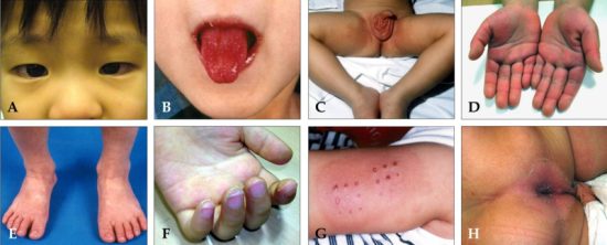 Symptoms Of Kawasaki Disease