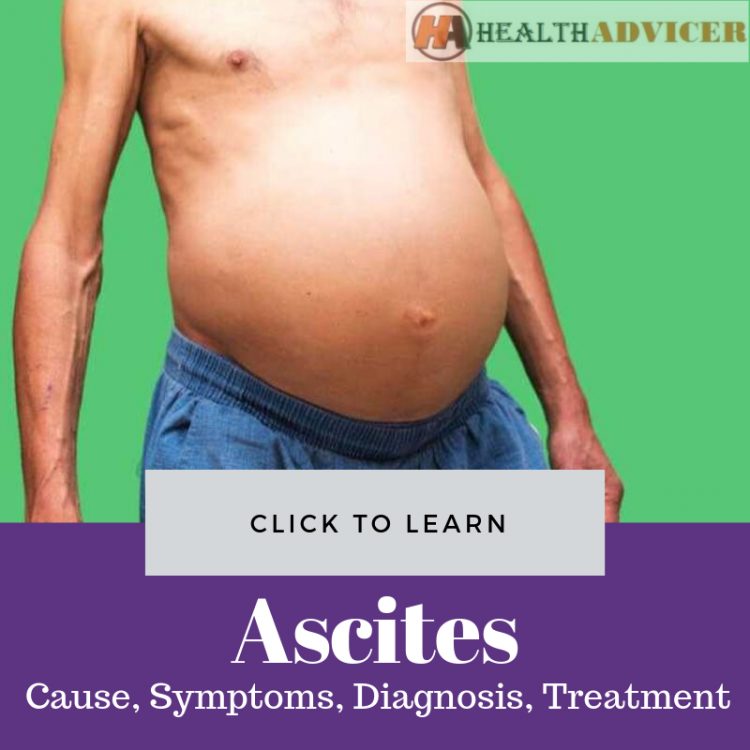 Ascites Picture