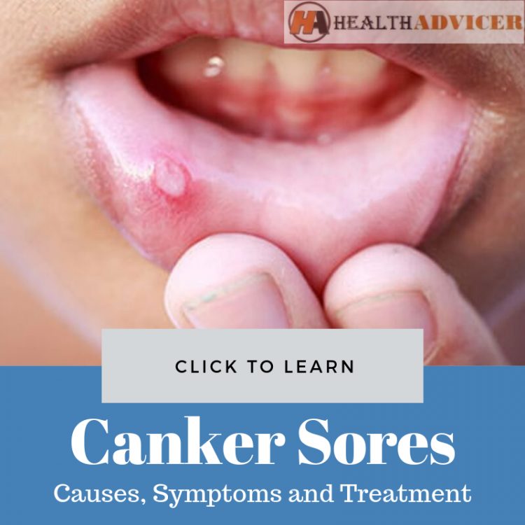 Canker Sores