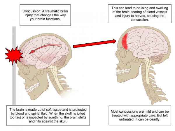 Head Trauma