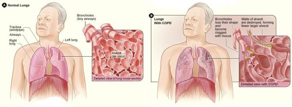 Chronic Obstructive Pulmonary Disease (COPD)