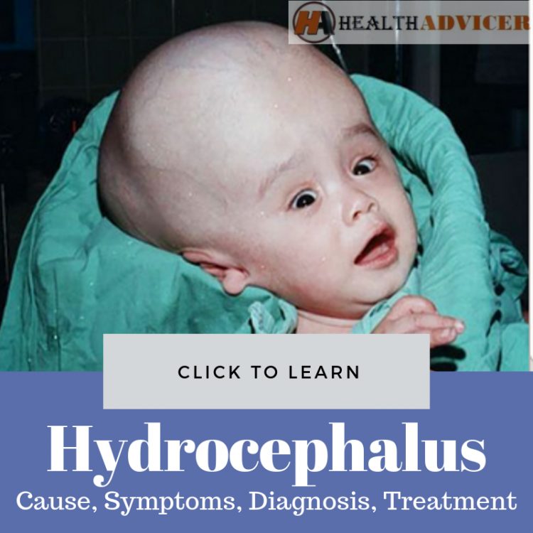 Hydrocephalus Causes Treatment