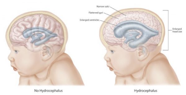 Causes Of Hydrocephalus