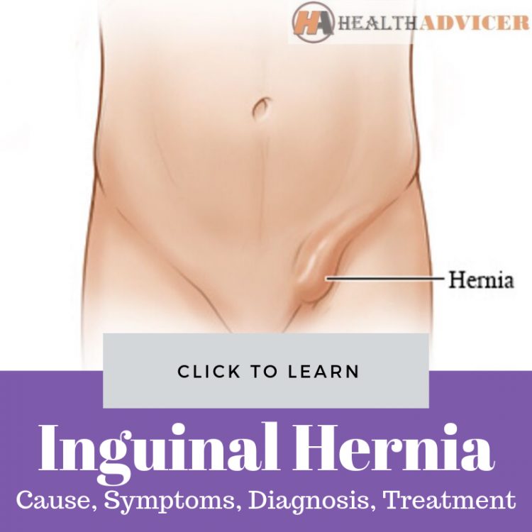 Inguinal Hernia