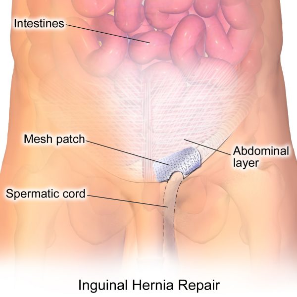 Inguinal Hernia Treatment Options