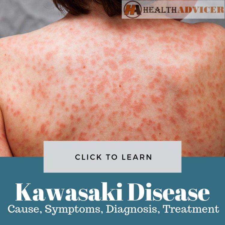 Kawasaki Disease Picture