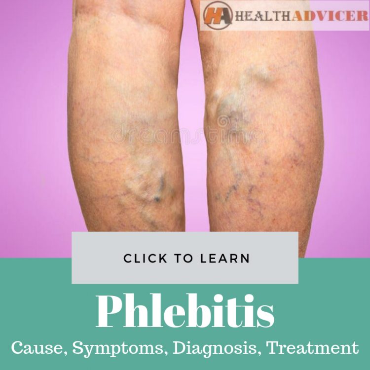 Phlebitis Picture