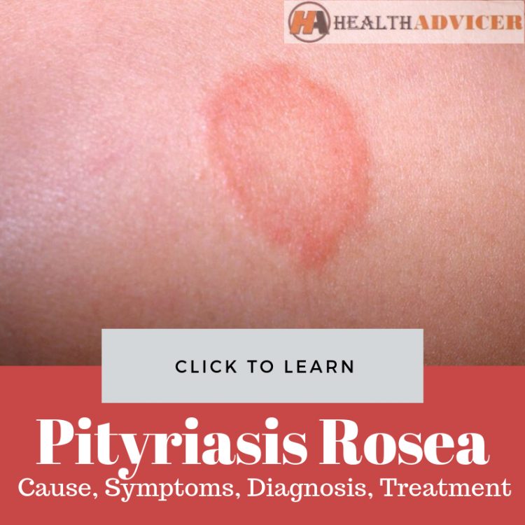 Pityriasis Rosea