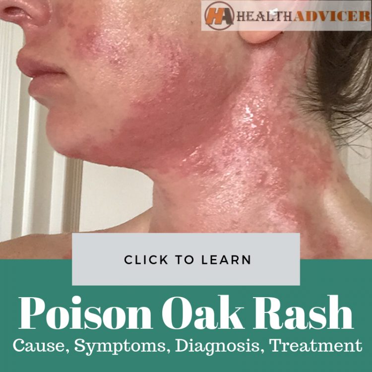 Poison Oak Rash Picture