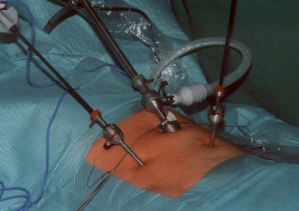 Laparoscopy Procedure