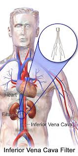 Filter Insertion