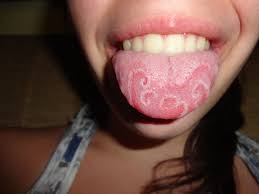 Geographic Tongue