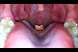 Epiglottitis