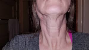 Difficulty in swallowing