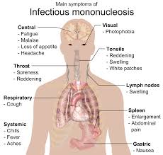 Infectious Mononucleosis