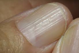 Ridges on fingernails