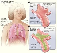 Bronchitis