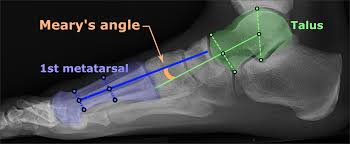 Cavus Foot