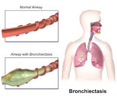 Bronchiectasis