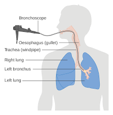 Bronchoscopy