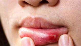 Symptoms Of Canker Sores: