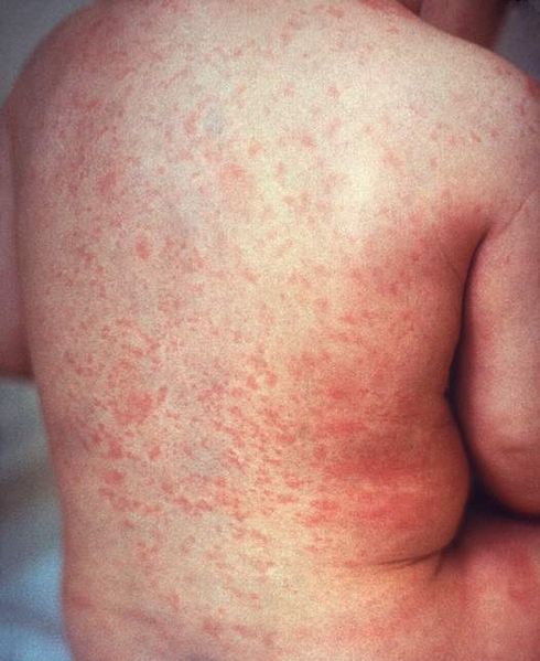 490px Rash of rubella on back crop