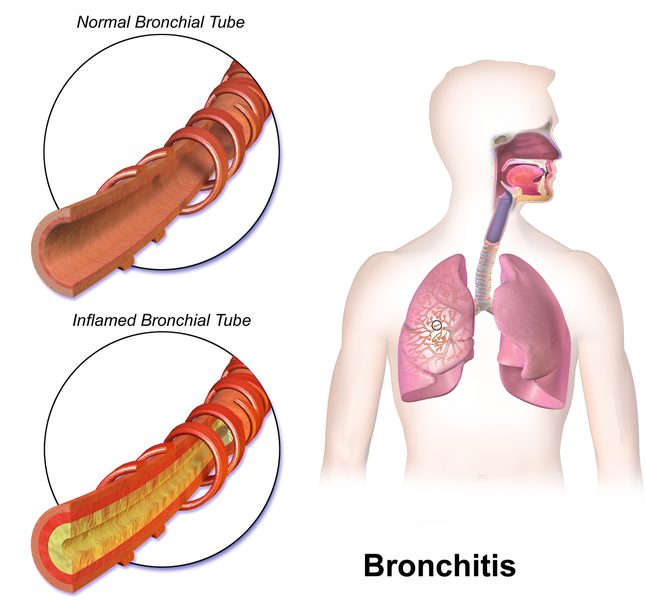 Bronchitis