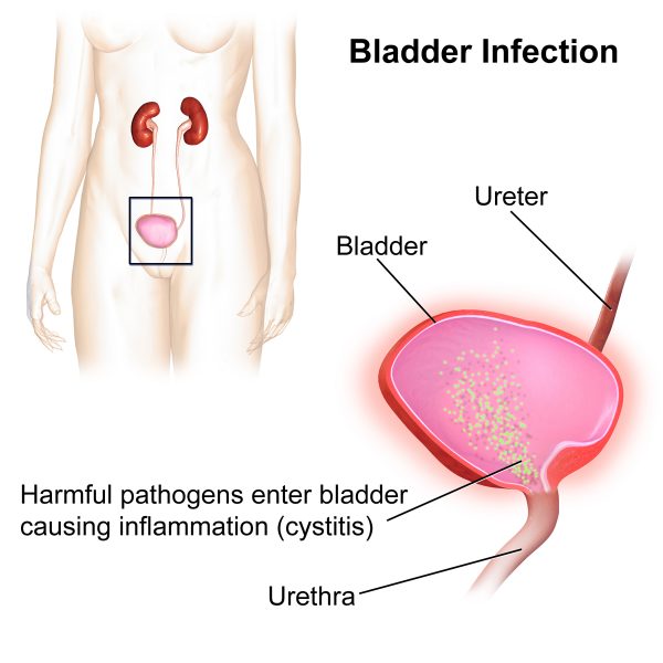 Urinary Tract Infections