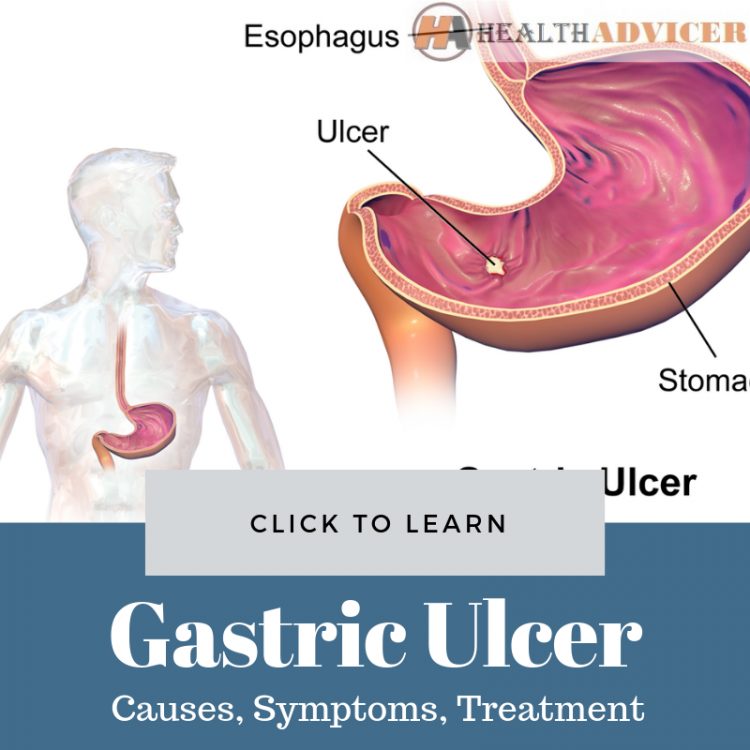 Gastric Ulcer