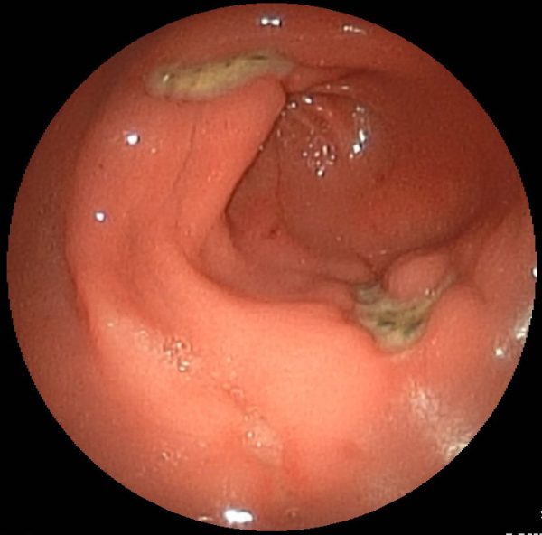 What Is A Gastric Ulcer