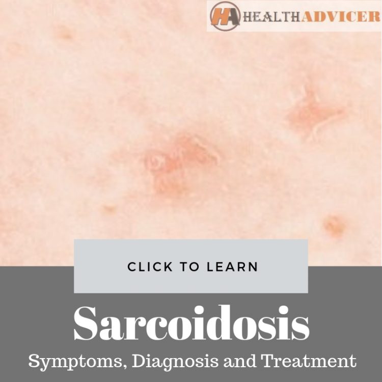 Sarcoidosis Picture