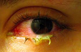 Viral And Bacterial Conjunctivitis