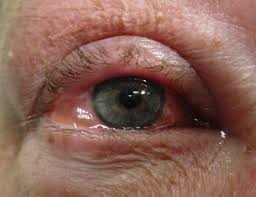 Allergic Conjunctivitis