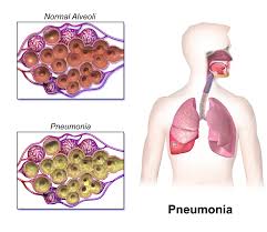 Pneumonia