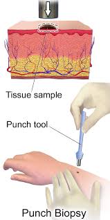 Skin Biopsy