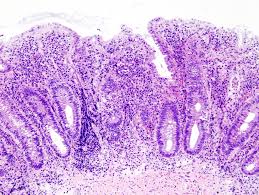 Endoscopic Biopsy