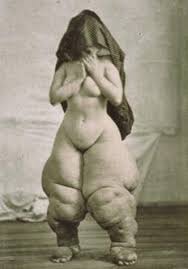 Elephantiasis