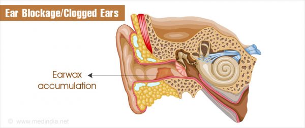 clogged ears