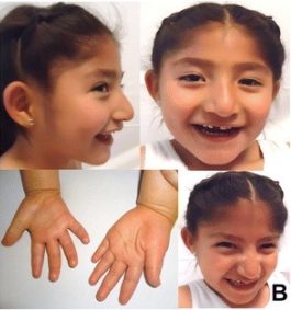 What Is Angelman Syndrome