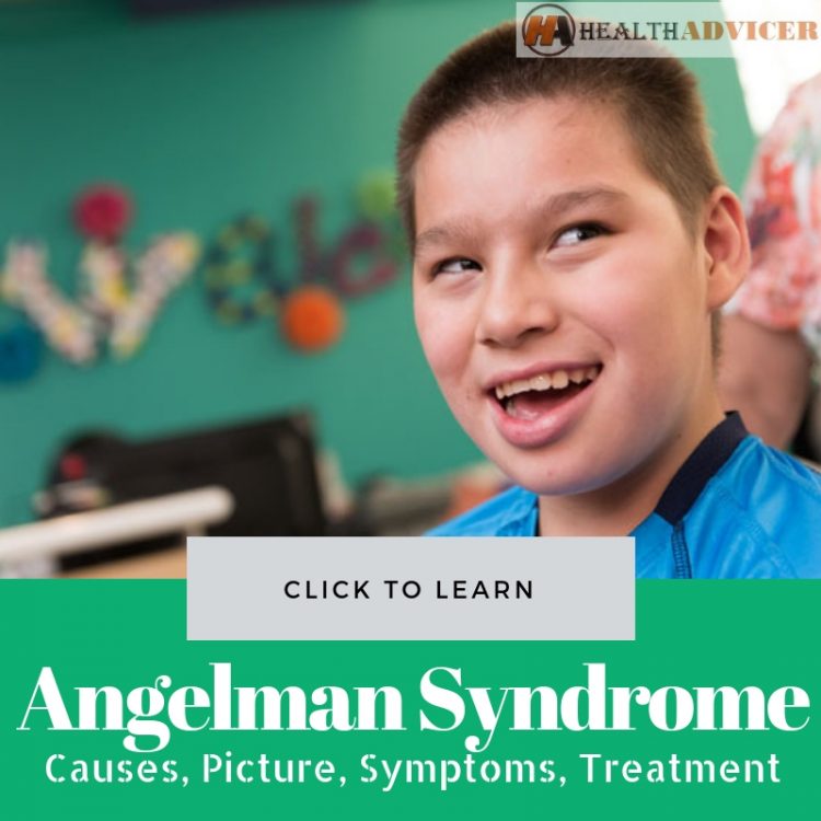 Angelman Syndrome Causes picture treatment