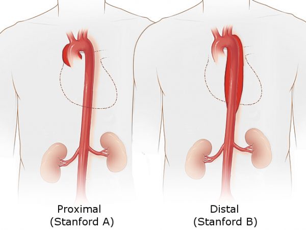 Aortic Dissection