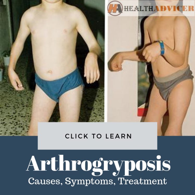 Arthrogryposis