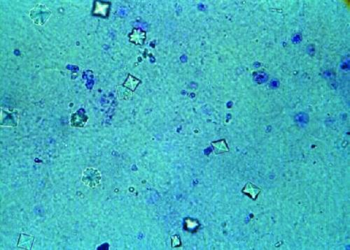 Calcium Oxalate Crystals
