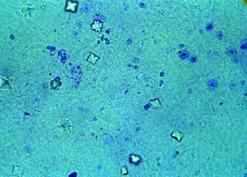 Calcium Oxalate Crystals