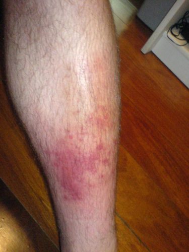 Secondary Skin Infection