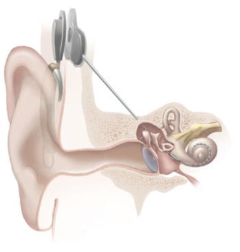 Hearing Loss