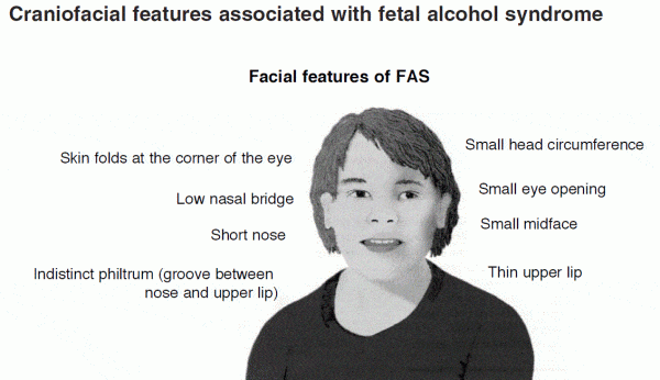 Fetal alcohol syndrome