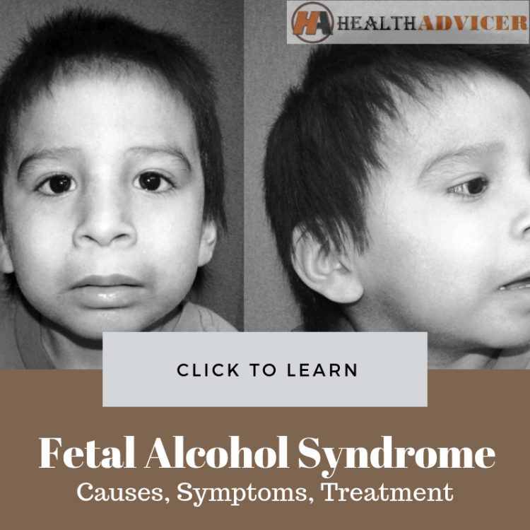 Fetal Alcohol Syndrome